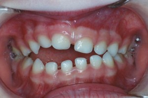pacifier teeth in adults